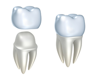 illustration of assembly of dental crowns Niceville, FL